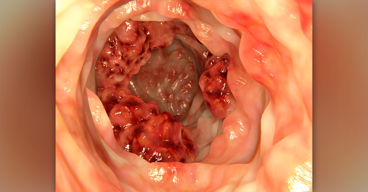 Characteristics of Advanced Colon Cancer