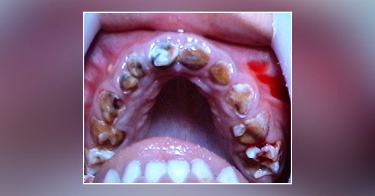 Case of a Young Boy with Severe Dental Caries