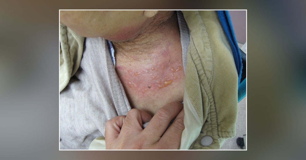 Sudden Onset of Painful Vesicles
