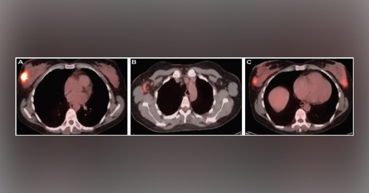 A Woman with Palpable Breast Mass: What Is Your Diagnosis?
