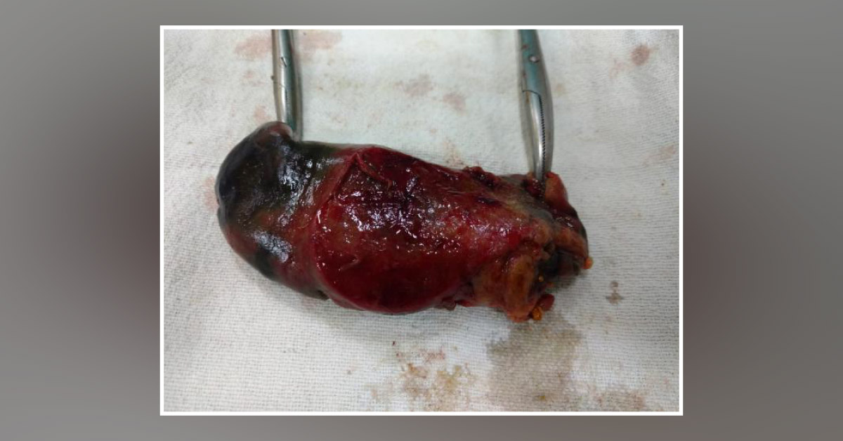 GB Perforation Without Stone Disease