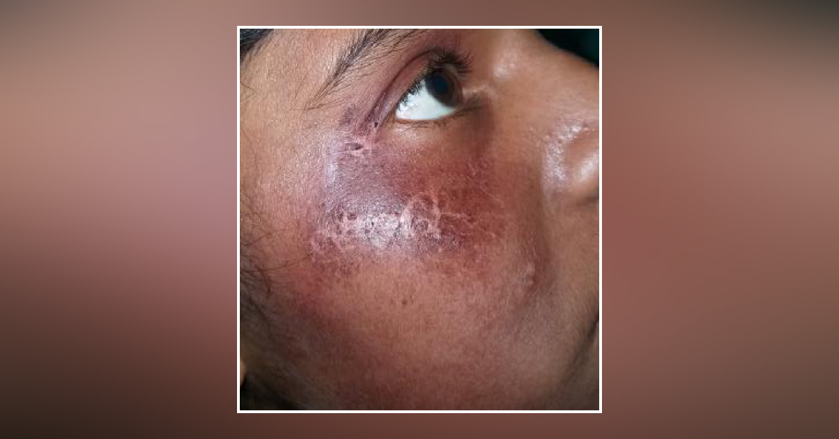 Cause And Treatment For Hyperpigmentation On Cheeks and Blistering On leg