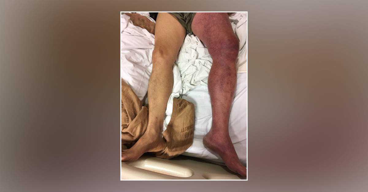 A Patient with Acute Limb Swelling