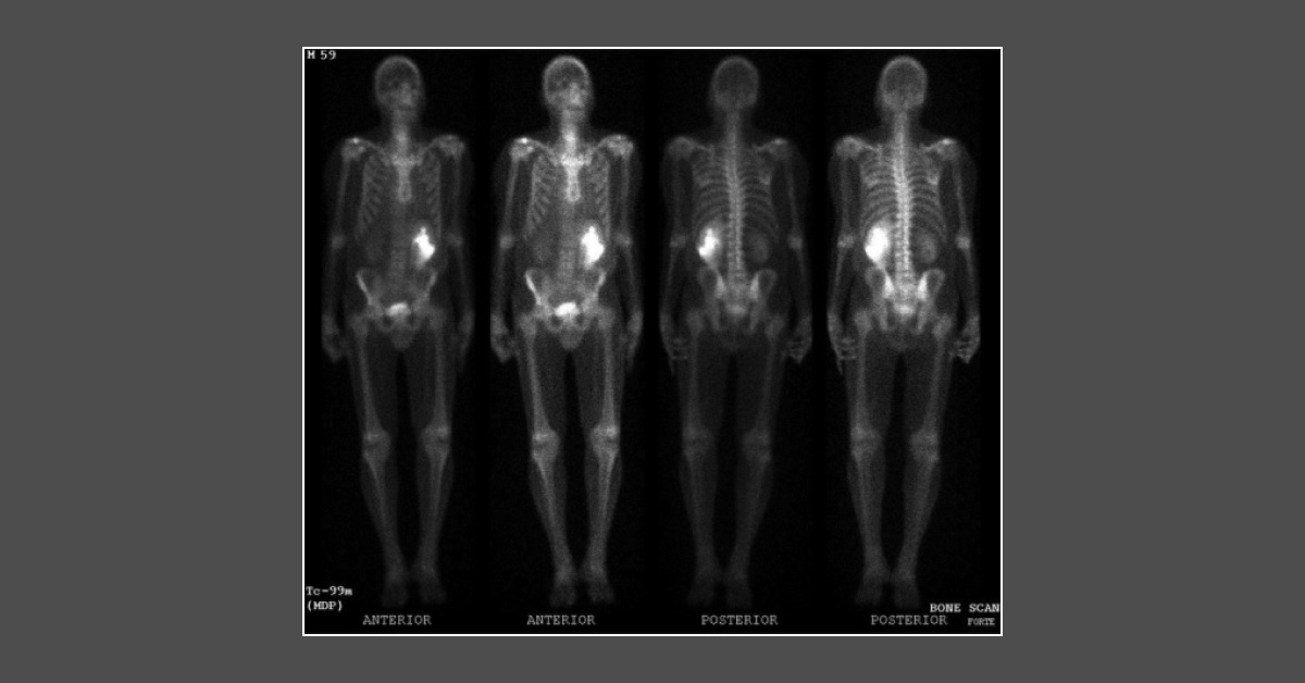 Case of a Man with Pain and Tenderness in His Left Loin