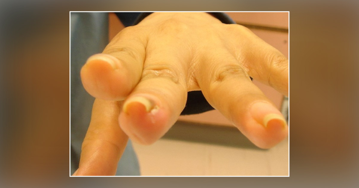 Nail Deformity — What is Your Diagnosis?