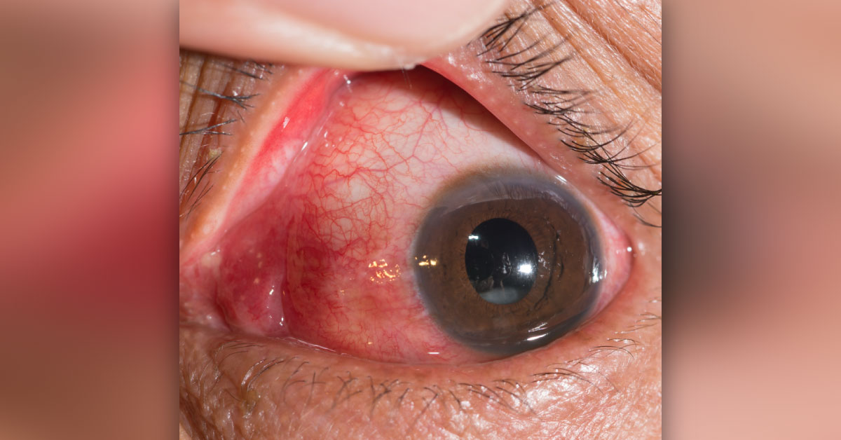 Causes Of Bilateral Granulomatous Panuveitis
