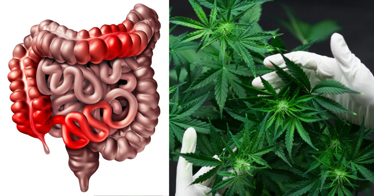 Cannabis Use Provides Symptom Relief In Crohn's Disease