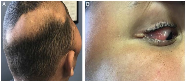 A Rare Neurocutaneous Syndrome: ECCL