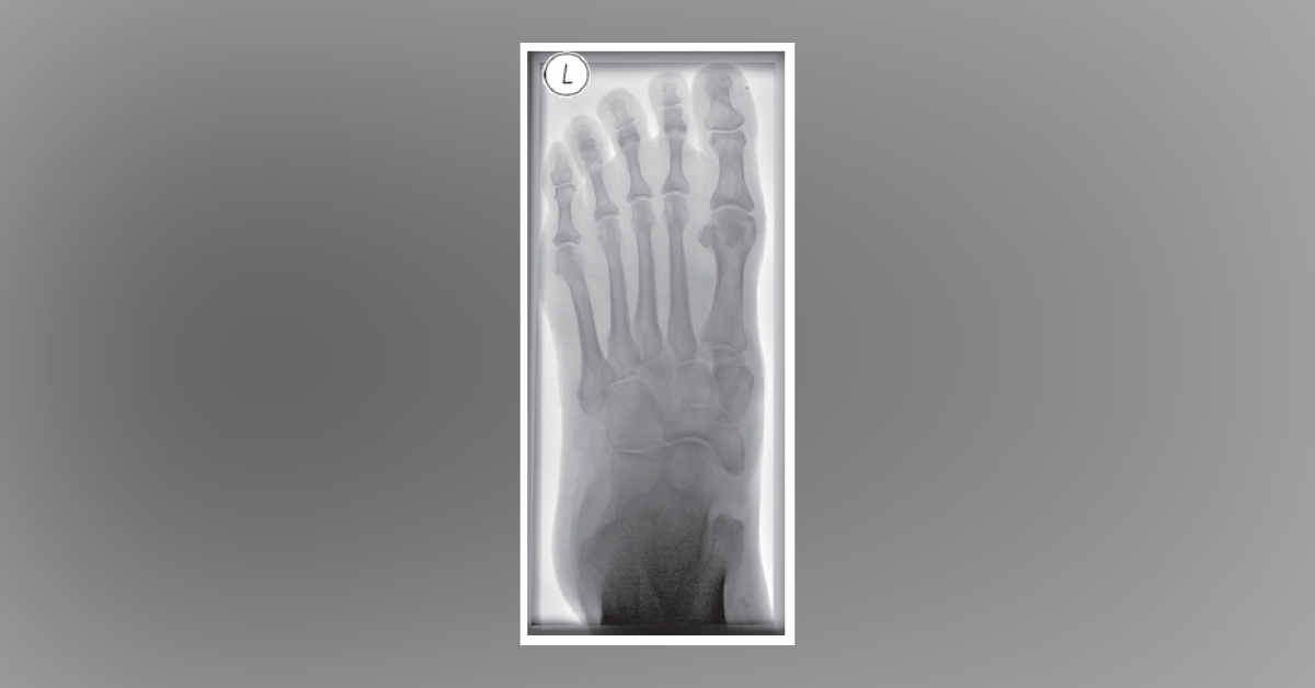 Traumatic Injury To A Farmer’s Foot