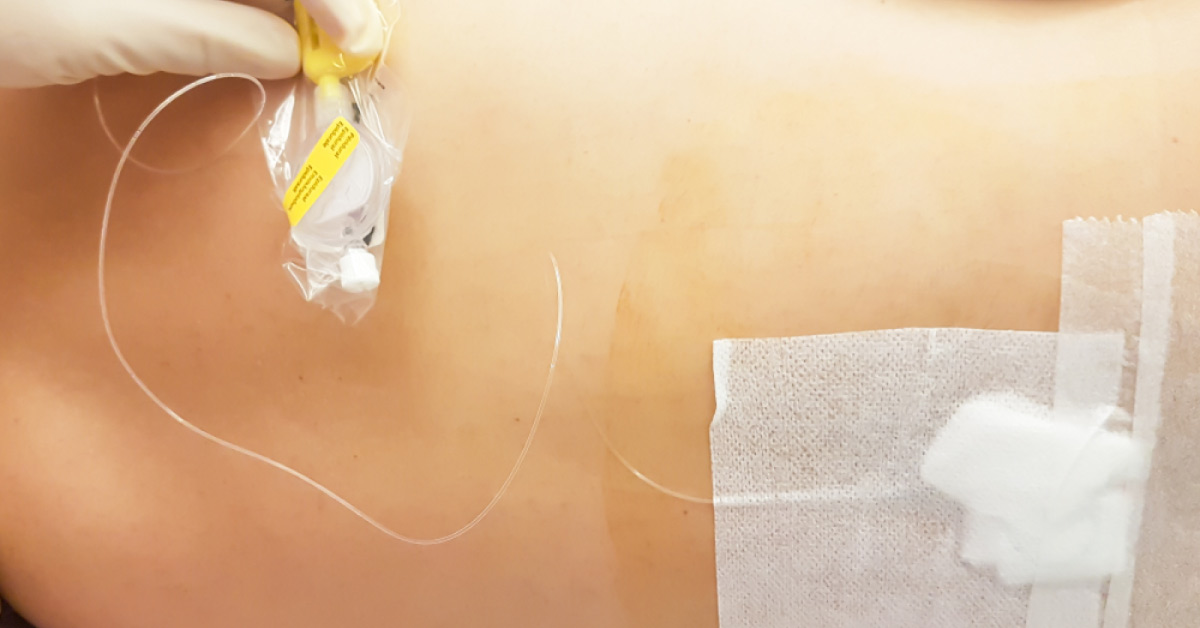 Epidural Anesthesia For Emergency Cesarean Section