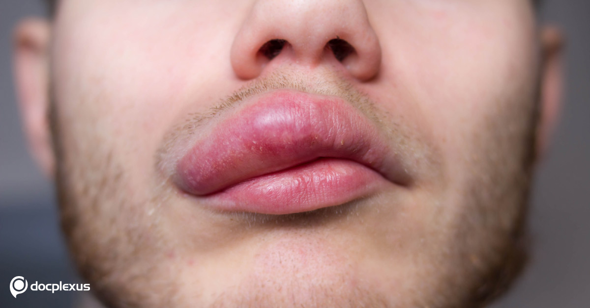 Treatment Options for Hereditary Angioedema