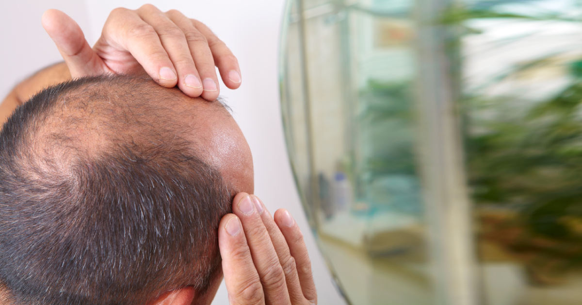 Platelet Rich Plasma Is The Treatment For Baldness: Study