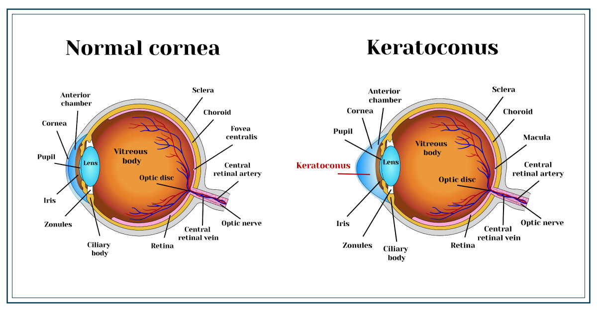 Causes Of Enlarged Or Visible Corneal Nerves