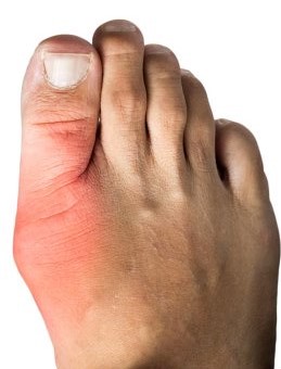 Drug Induced Gout
