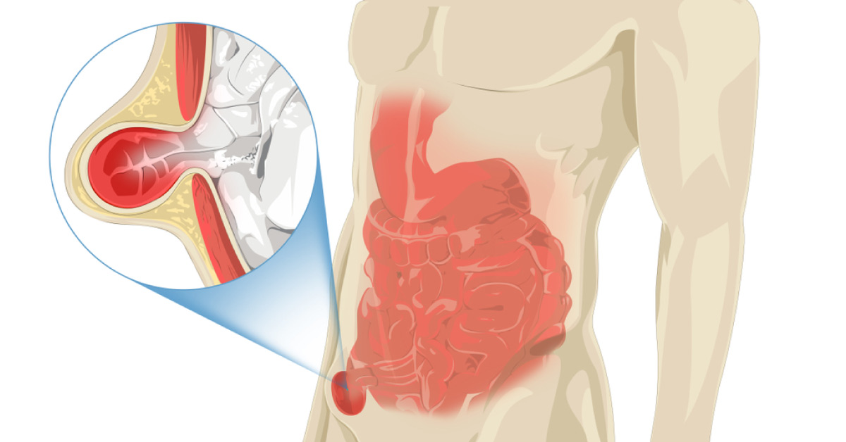 Age-related Spike In Estrogen May Lead To Inguinal Hernia In Men