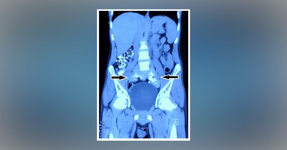 Case of a Young Boy with Acute Intestinal Obstruction