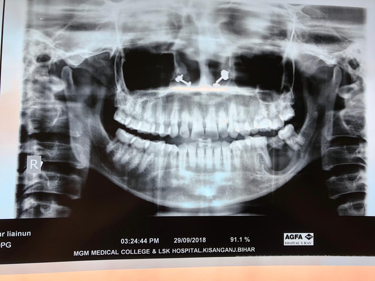 Case Of Cystic Swelling Of Mandible