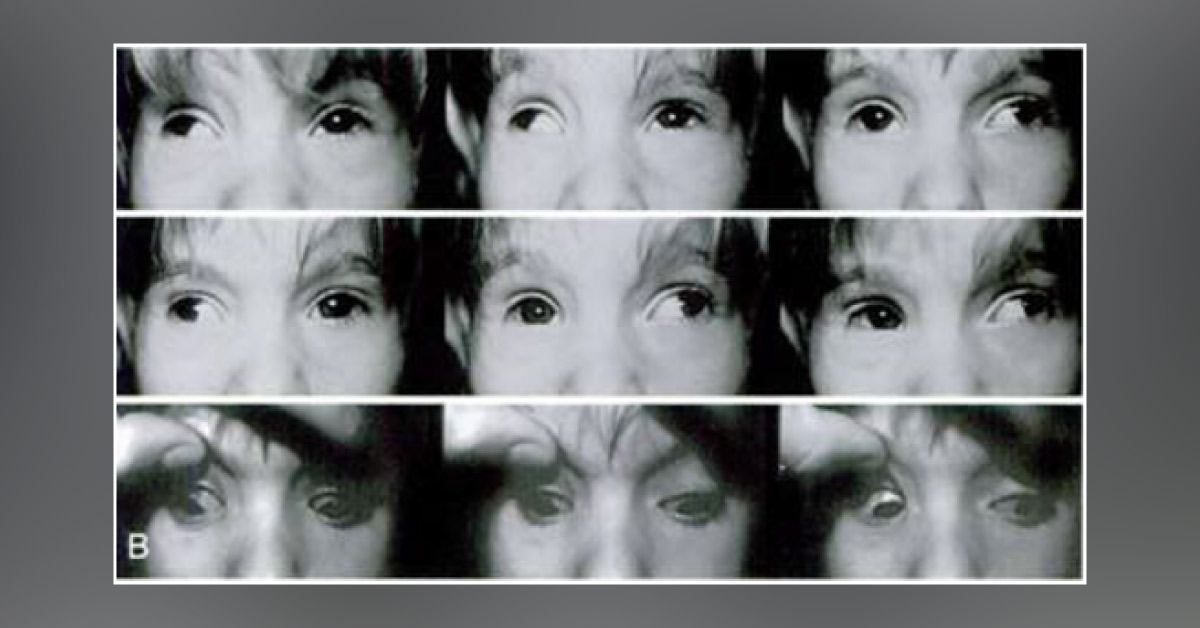A Rare Strabismus Disorder