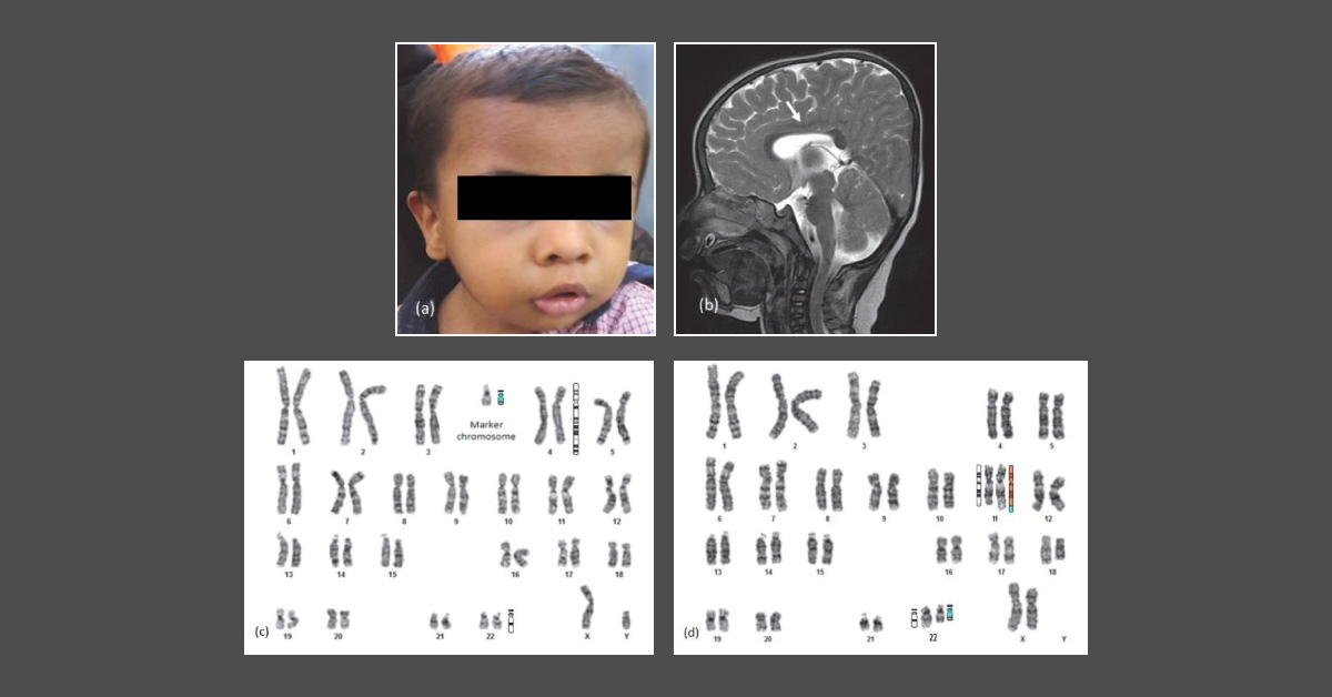 Case of an Infant with Developmental Disability and Dysmorphism