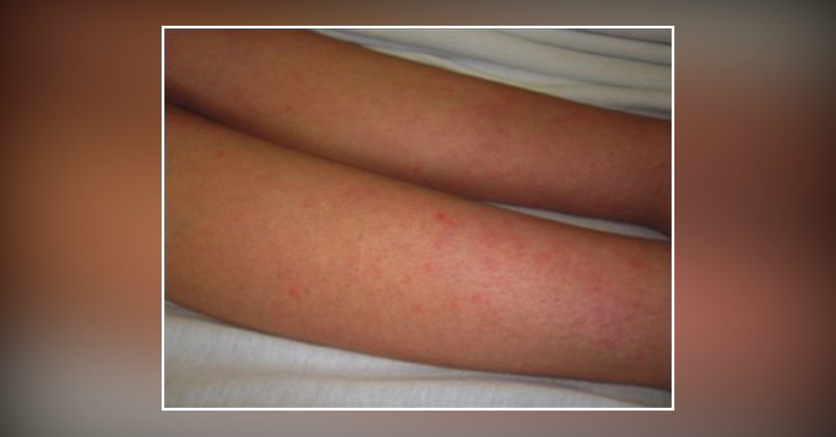 What's Causing These Rashes?