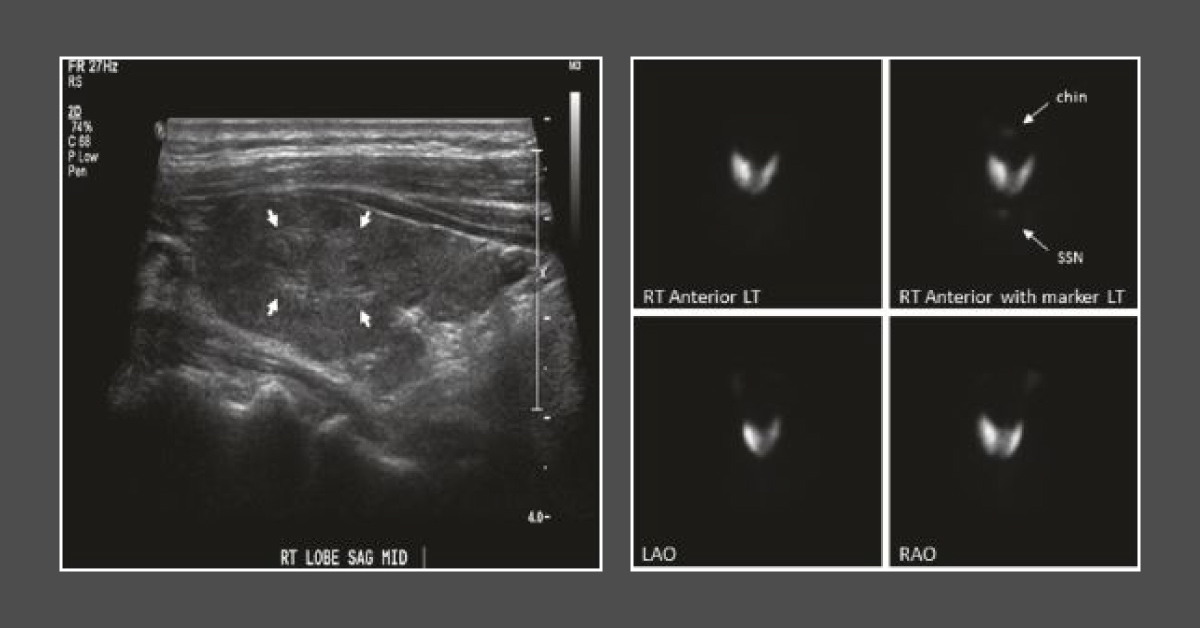 An Elderly Woman with Exopthalmia and Abnormal Thyroid Levels