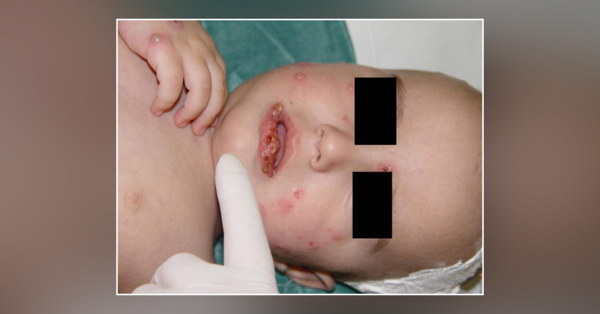 A Child with Papular and Nodular-pustular Lesions