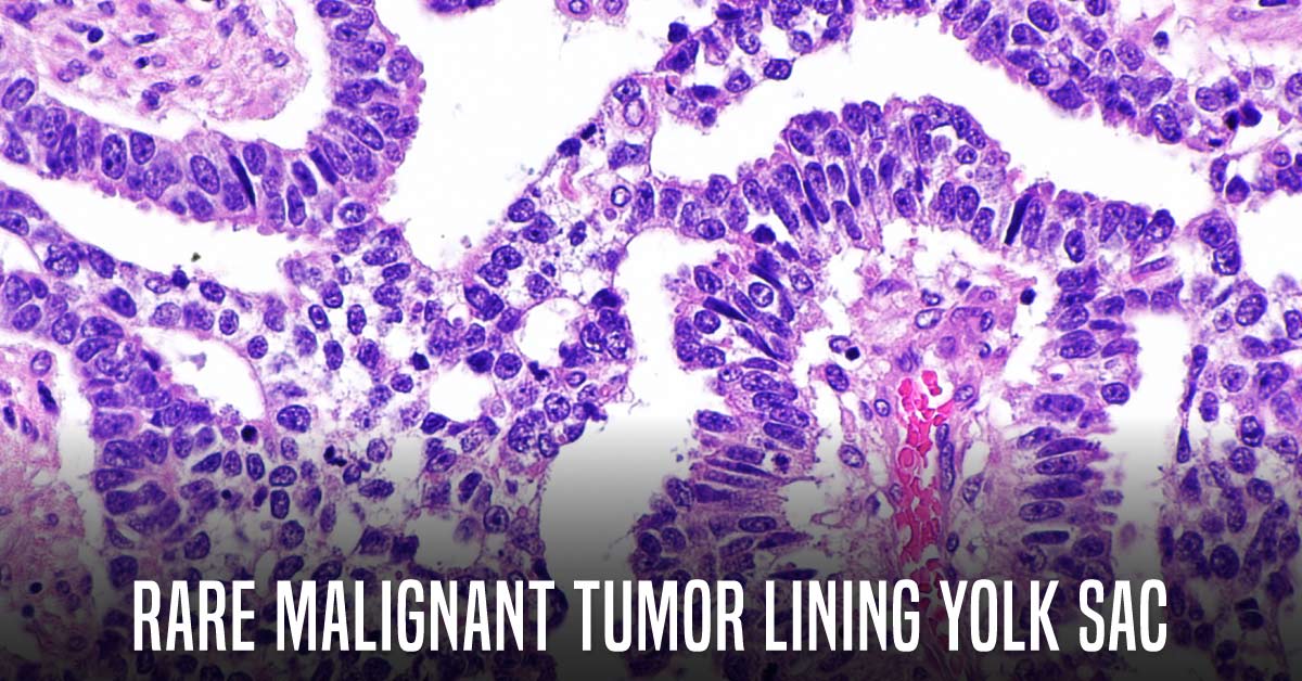 Germ Cell Tumor: Malignant Tumor Lining the Yolk Sac