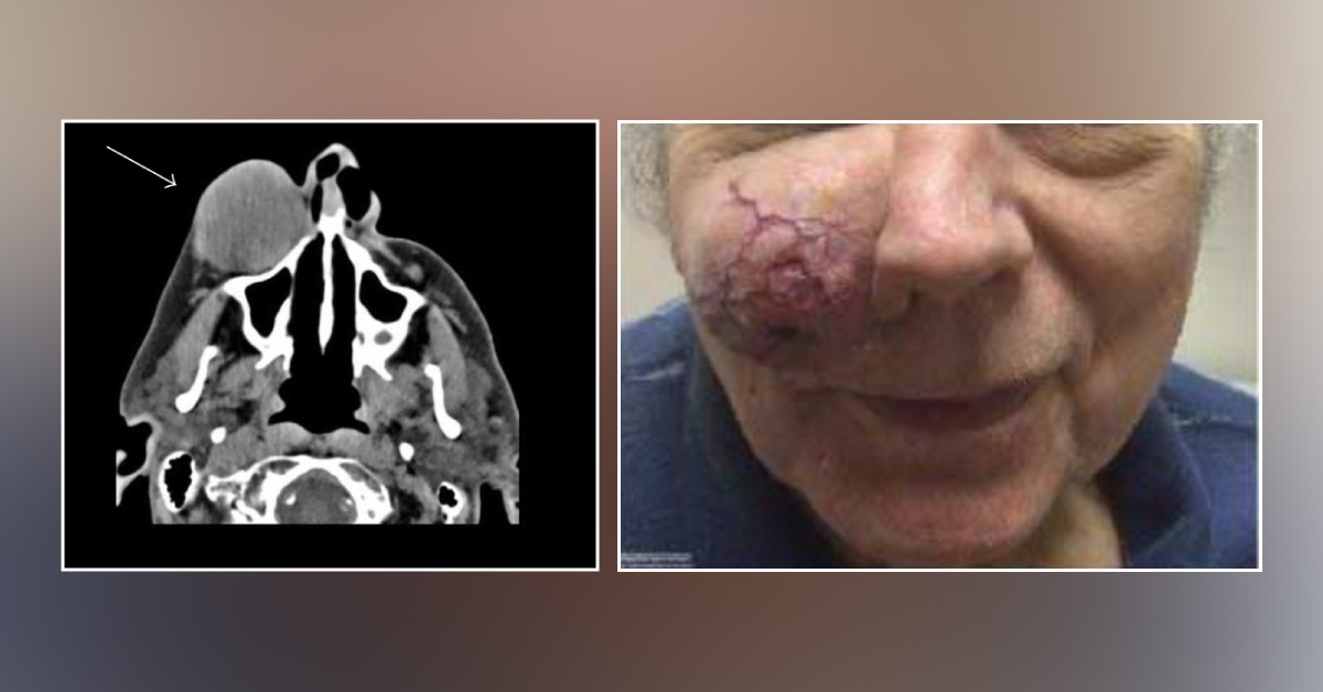 Elderly Male With an Enlarging Right Cheek Mass