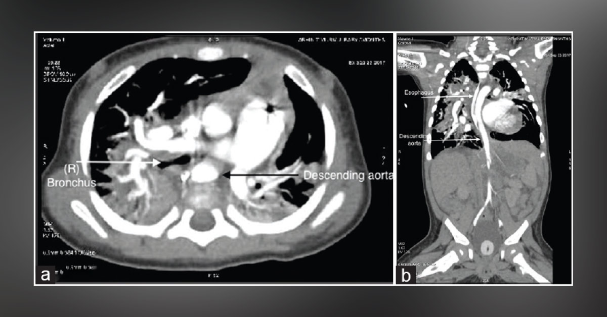 Case of an Infant with Respiratory Distress