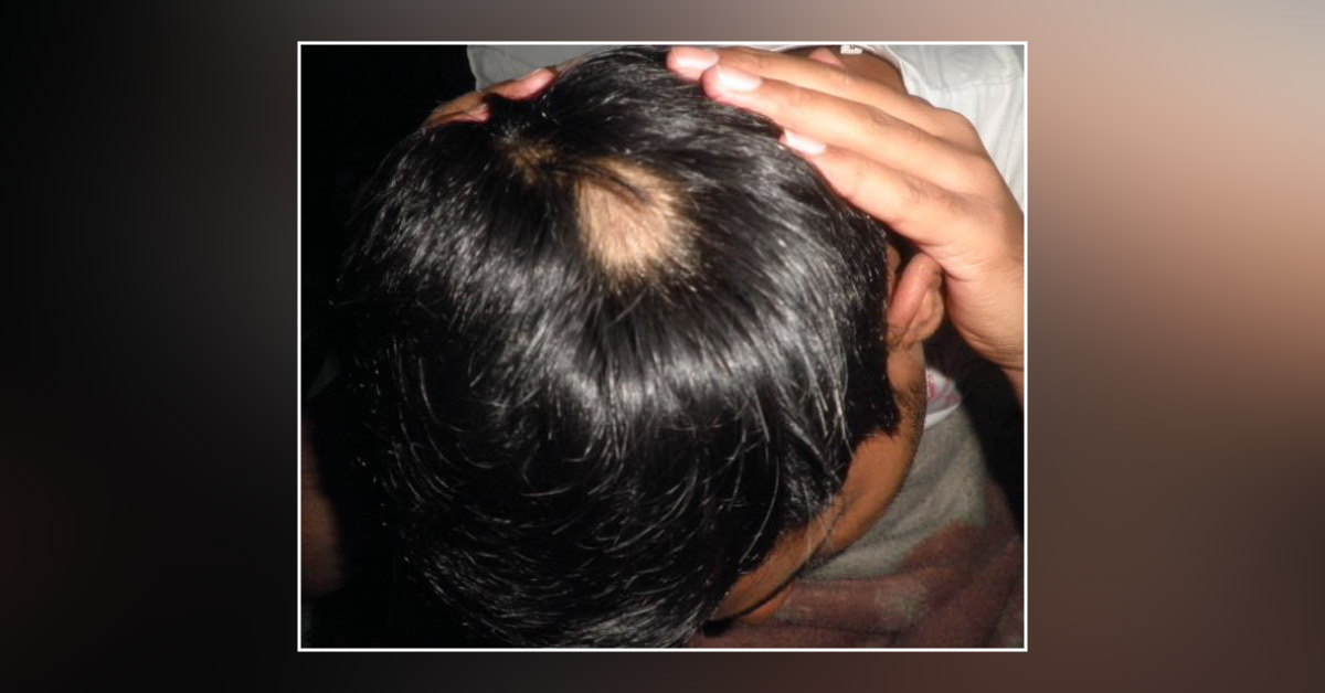 Case Of Alopecia Areata