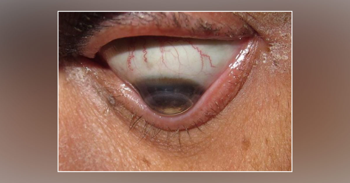 Recent Modalities In The Treatment Of Keratoconus