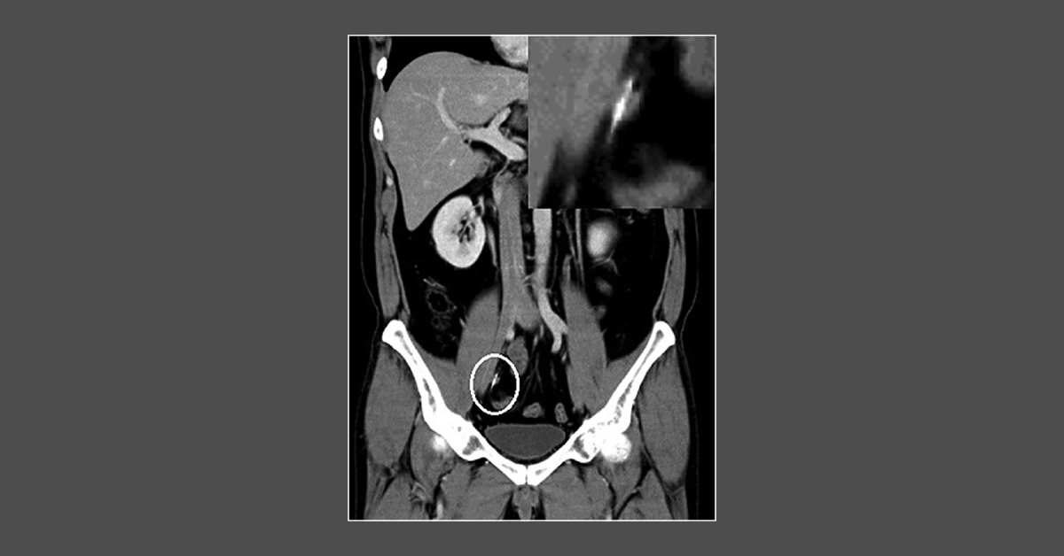 Accidental Ingestion of a Dental Instrument