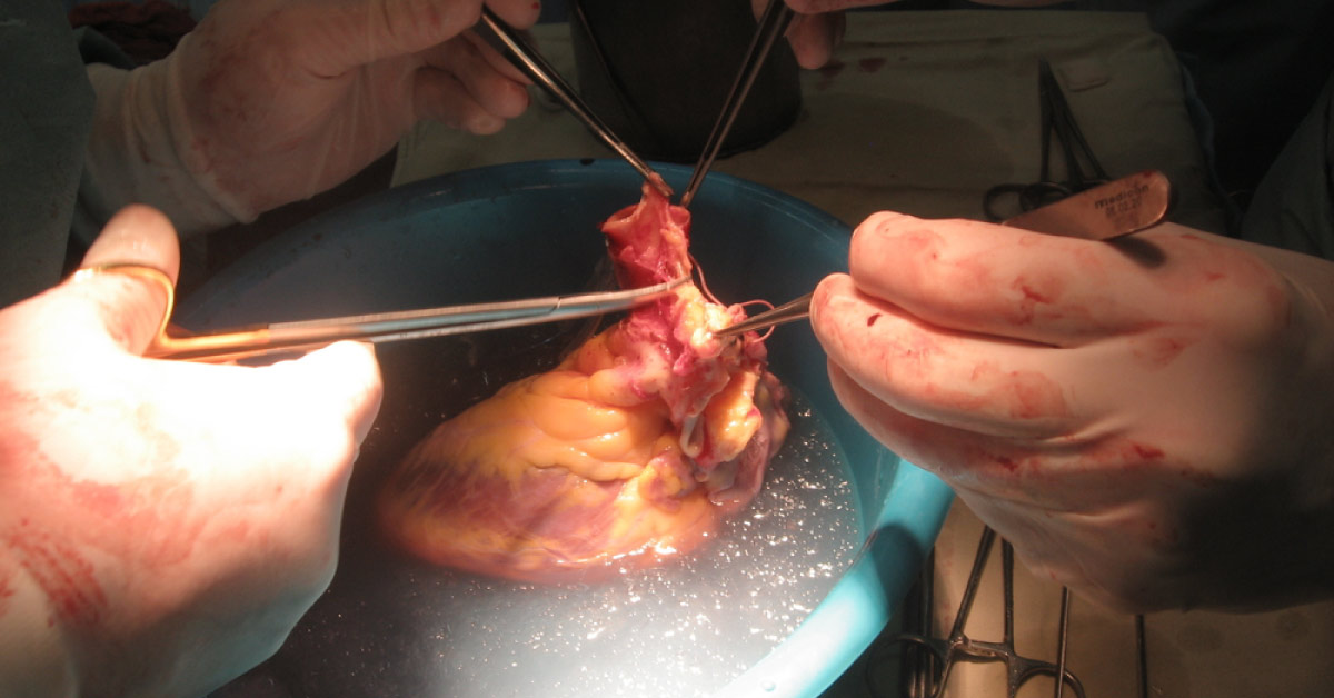 Status Of Cardiac Transplantation In India