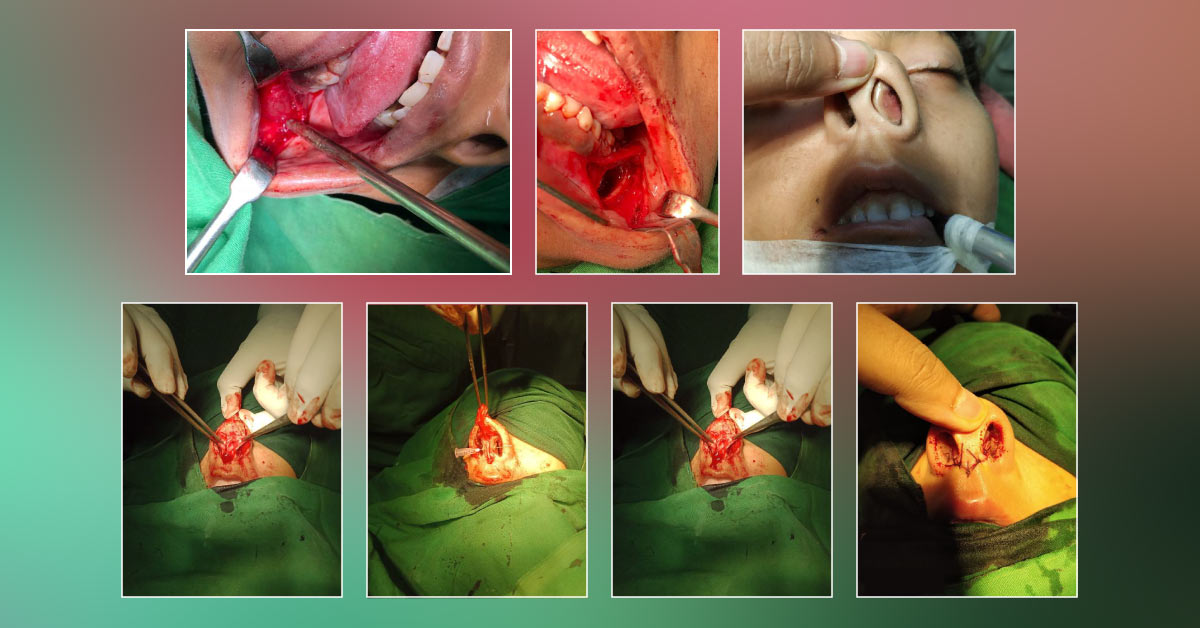 Case Of Caudal Deviation Of Nasal Septum