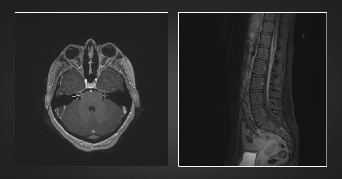 A Case of Lower Extremity Weakness and Blurry Vision
