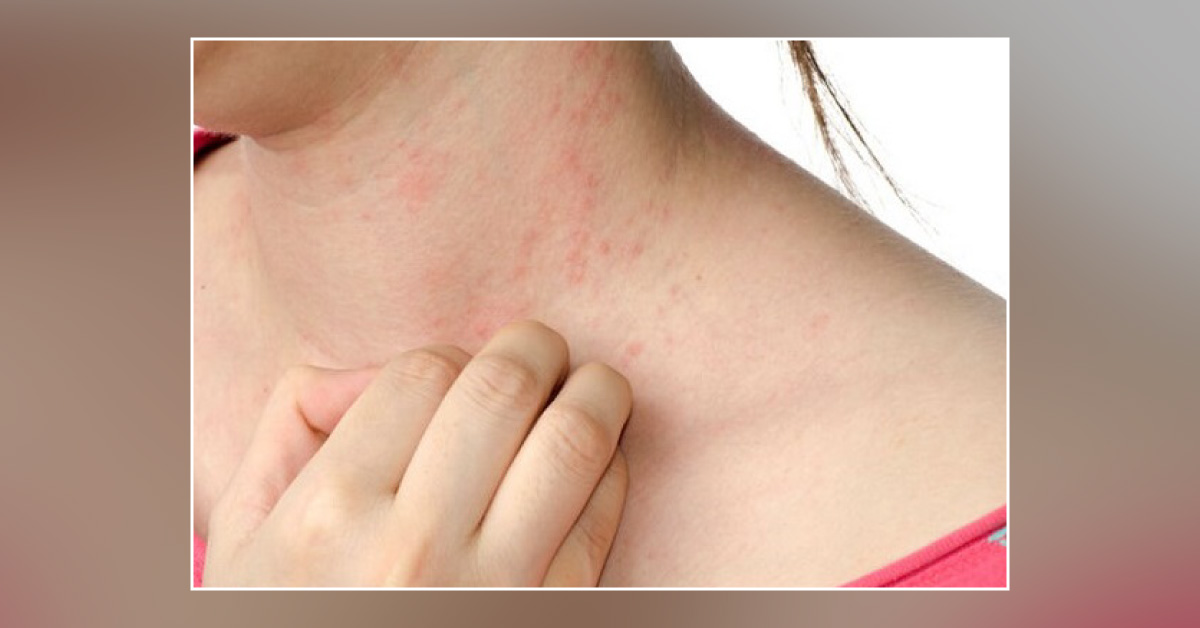A 16-year-old Girl with a Rash and Shortness of Breath