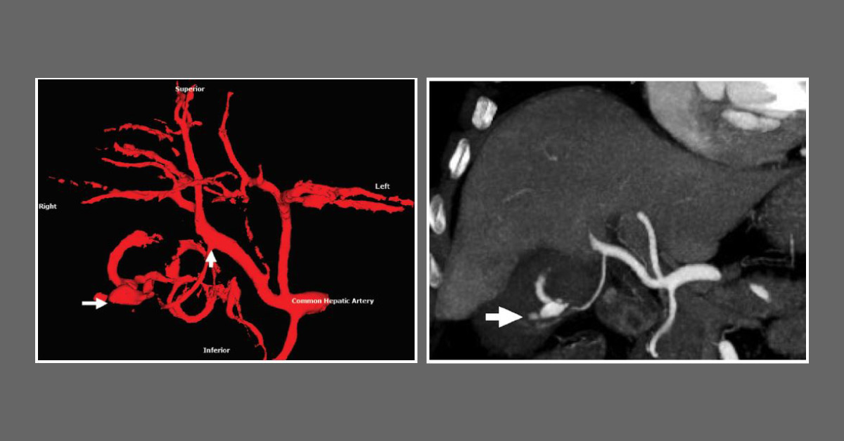 What's Your Diagnosis for This Man Suffering from Abdominal Pain, Hypotenstion and Tachycardia?