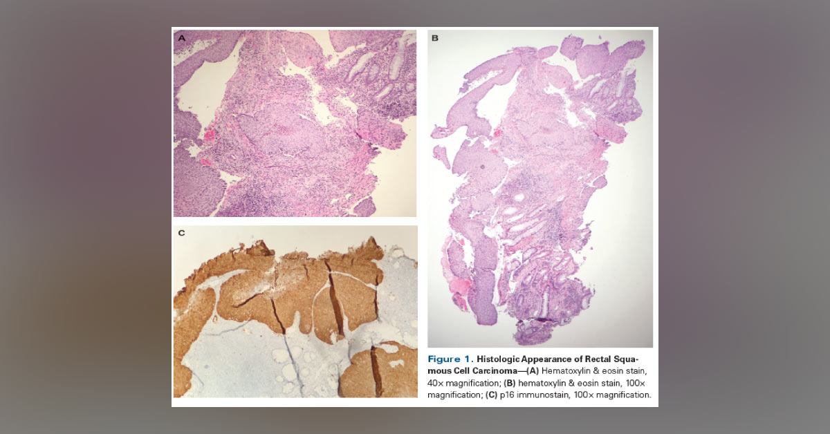 Woman With Rare Cause Of Rectal Bleeding