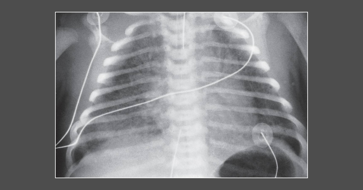 Case of a Newborn with Grunting Sound While Breathing