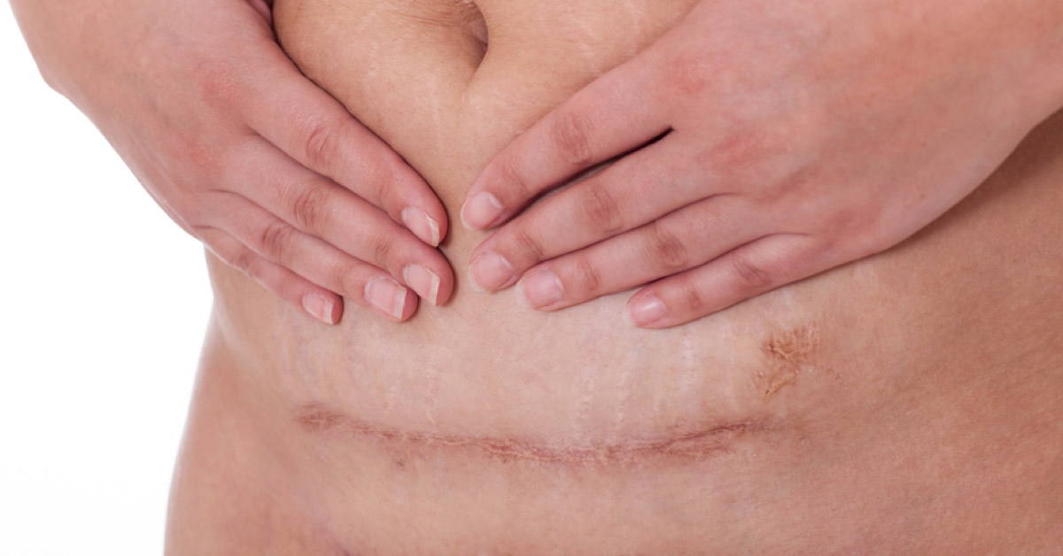 Genital Swelling Following Cesarean Delivery