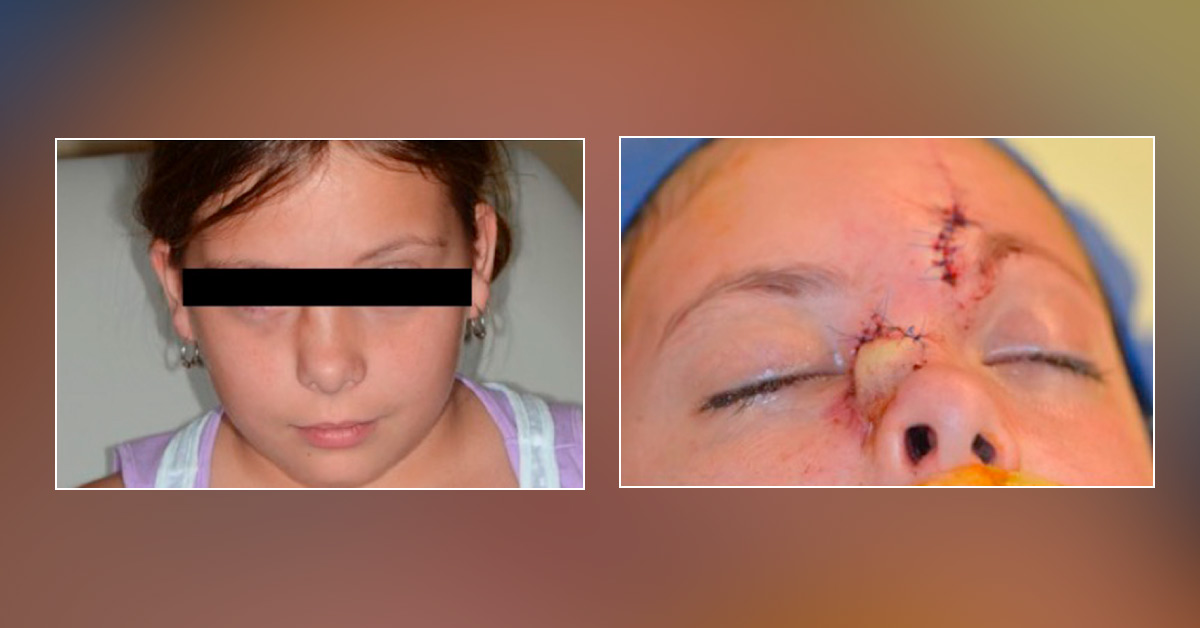 Atypical Spindle Cell Neoplasm of the Nasal Sidewall