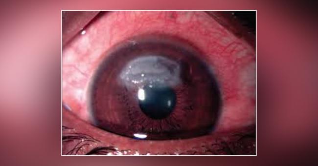 Features Of Vernal Or Shield Ulcer