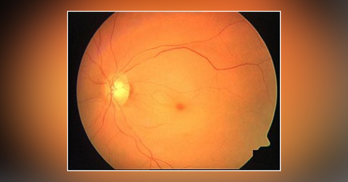 Brief Review On Cause Of Visible Or Enlarged Corneal Nerves