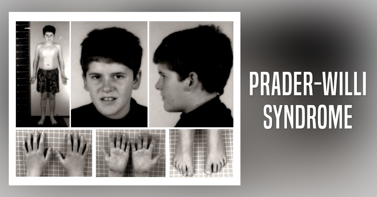 Prader-Willi Syndrome: A Rare Genetic Disorder