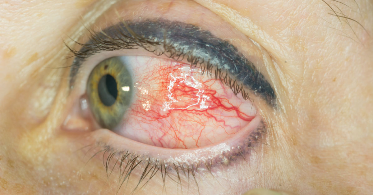 Diagnostic And Treatment Modalities Of Choroidal Melanoma
