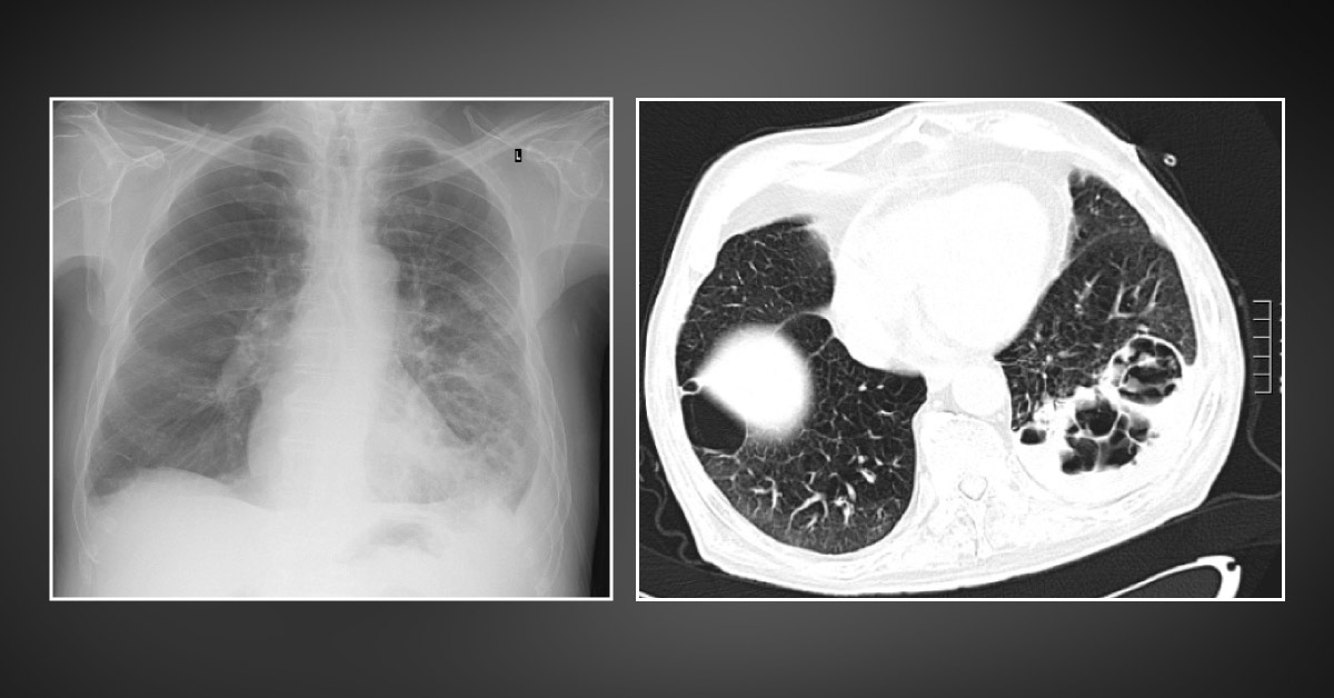 A Case of a Deadly Respiratory Disease