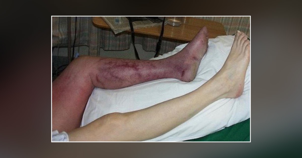Sudden Onset Blue Leg