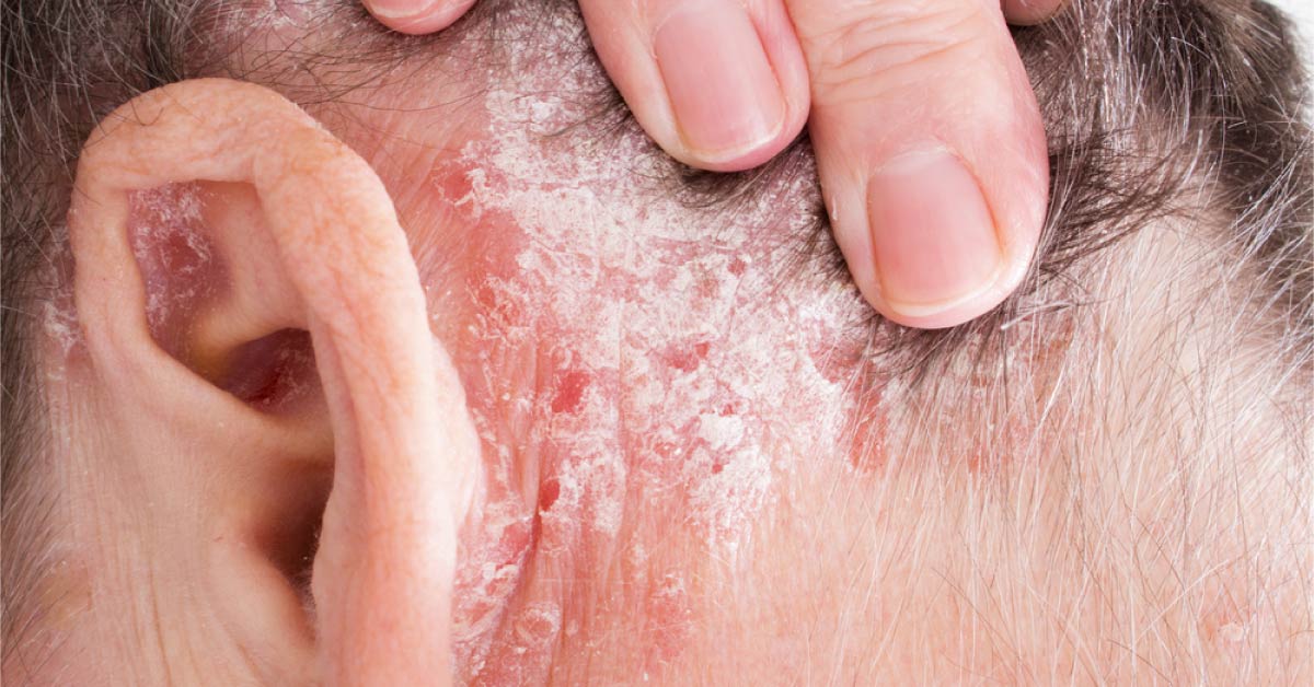 Is Psoriasis Associated With Thyroid Disease?