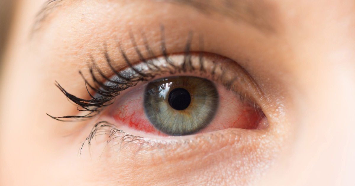 Brief On Medication Of Vernal Keratoconjunctivitis