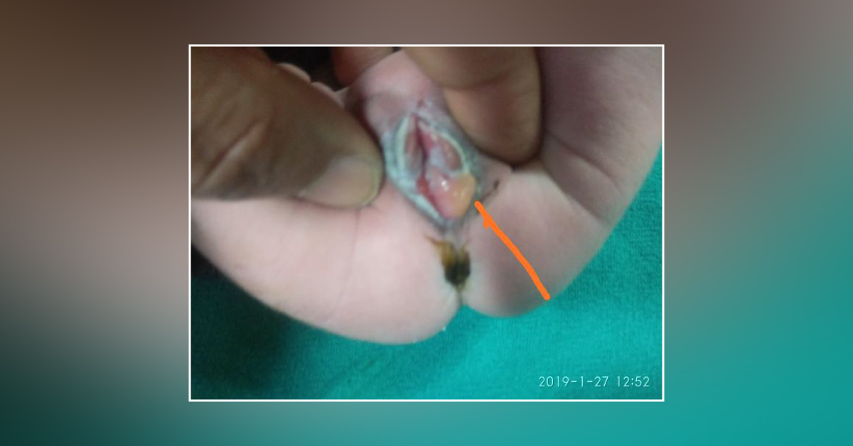Newborn Having Abnormal Vaginal Growth